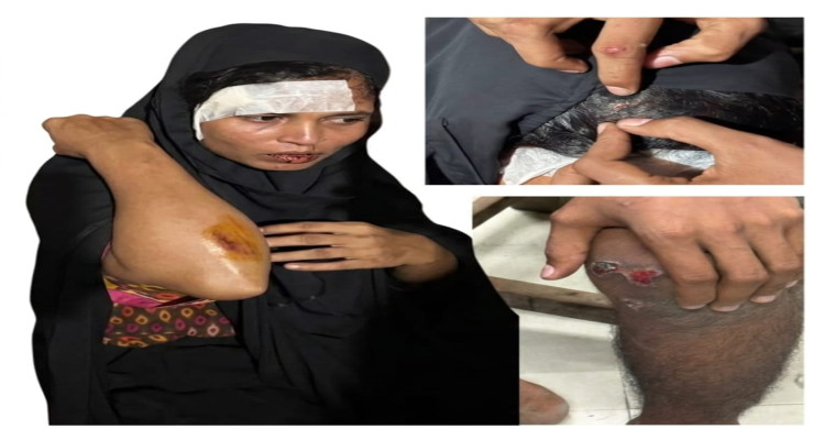 বরুড়ায় দেবরের লাঠির আঘাতে ভাবি-ভাতিজা রক্তাক্ত মাথা ফাটিয়ে দাঁত ফেলে দেওয়ার অভিযোগ, ছেলেকেও পেটানোর দাবি